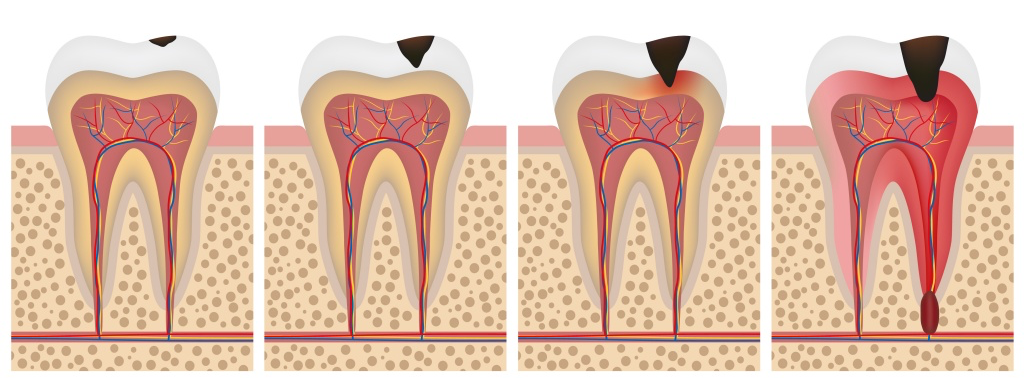 Чувствительность зубов после лечения. Поверхностный и средний кариес.